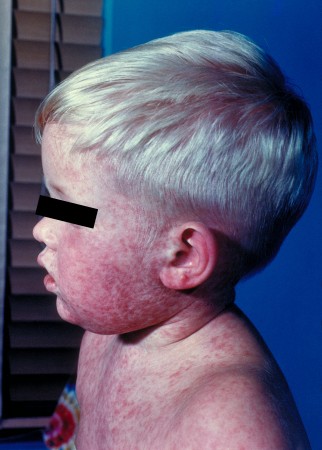 A child with measles. Source: Centers for Disease Control