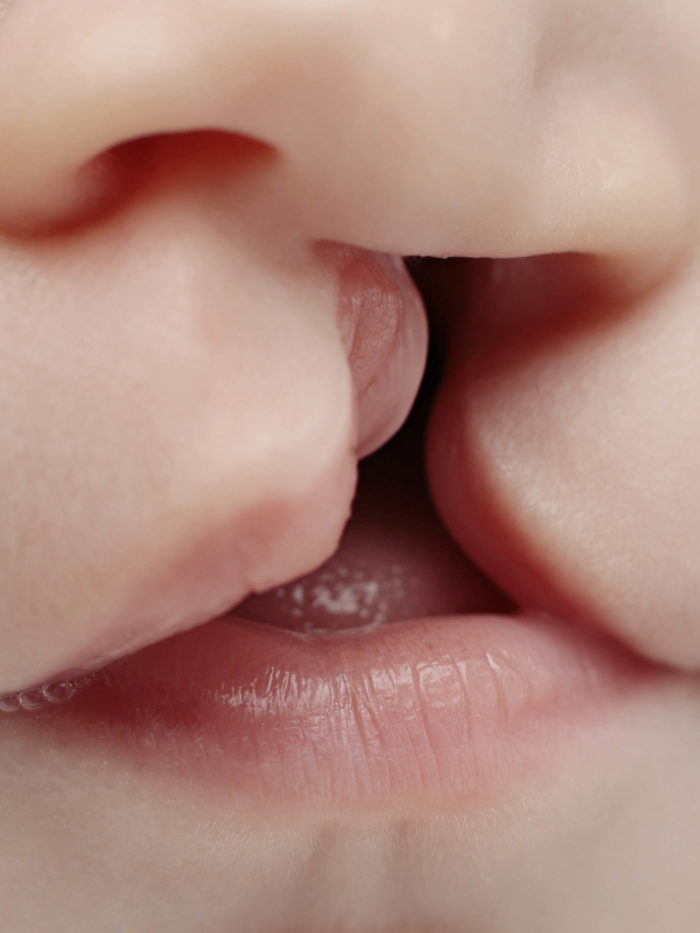 Genetic Syndrome Causes Cleft Lip, Palate in Sisters