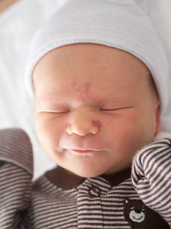 Newborn baby with a birthmark on his forehead smiling while asleep