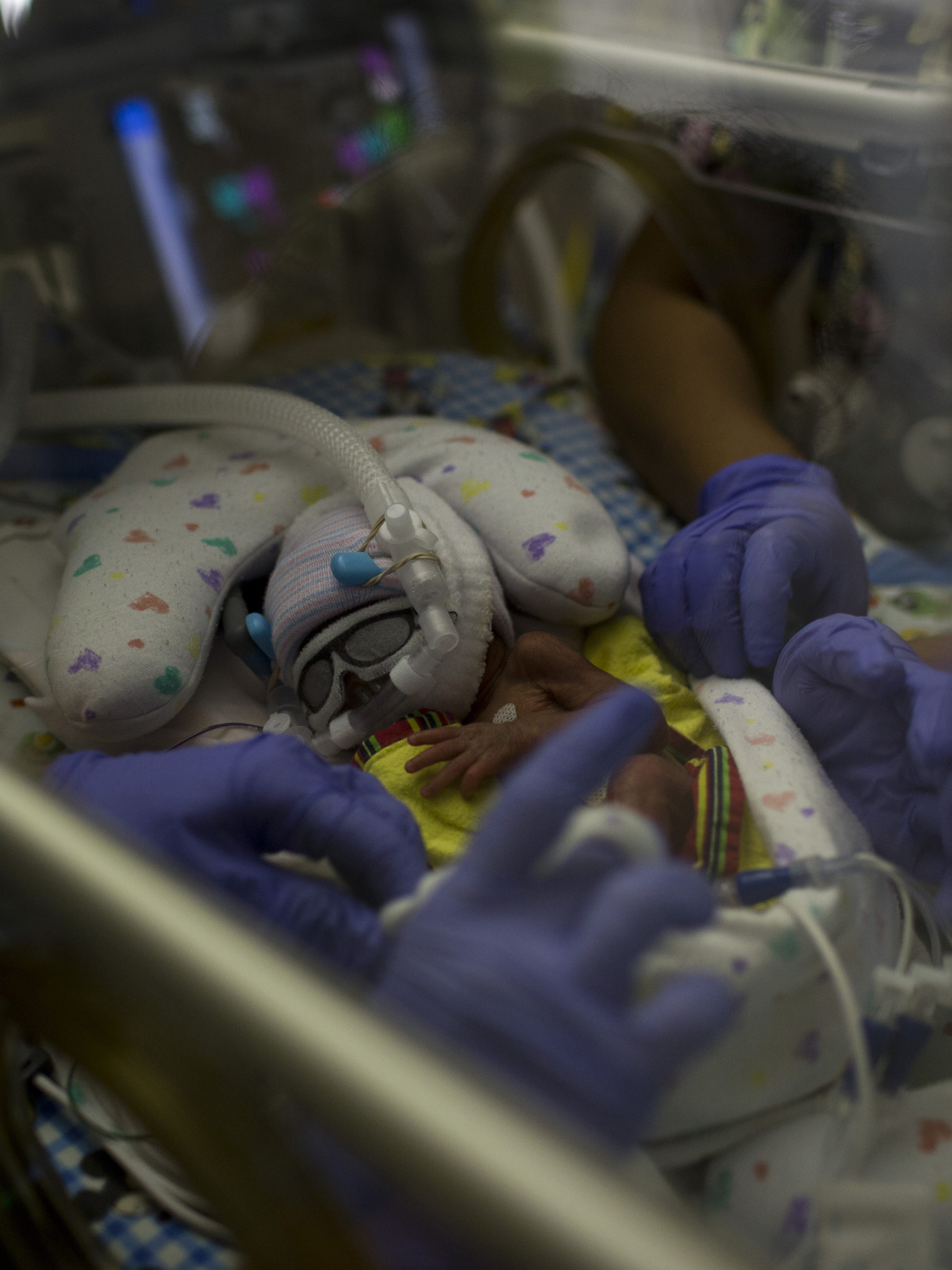 tiny baby wearing googles in incubator in CHOC small baby unit