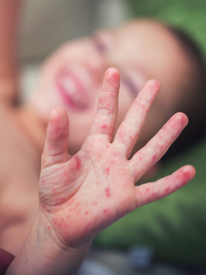 closeup of rash hand foot and mouth disease