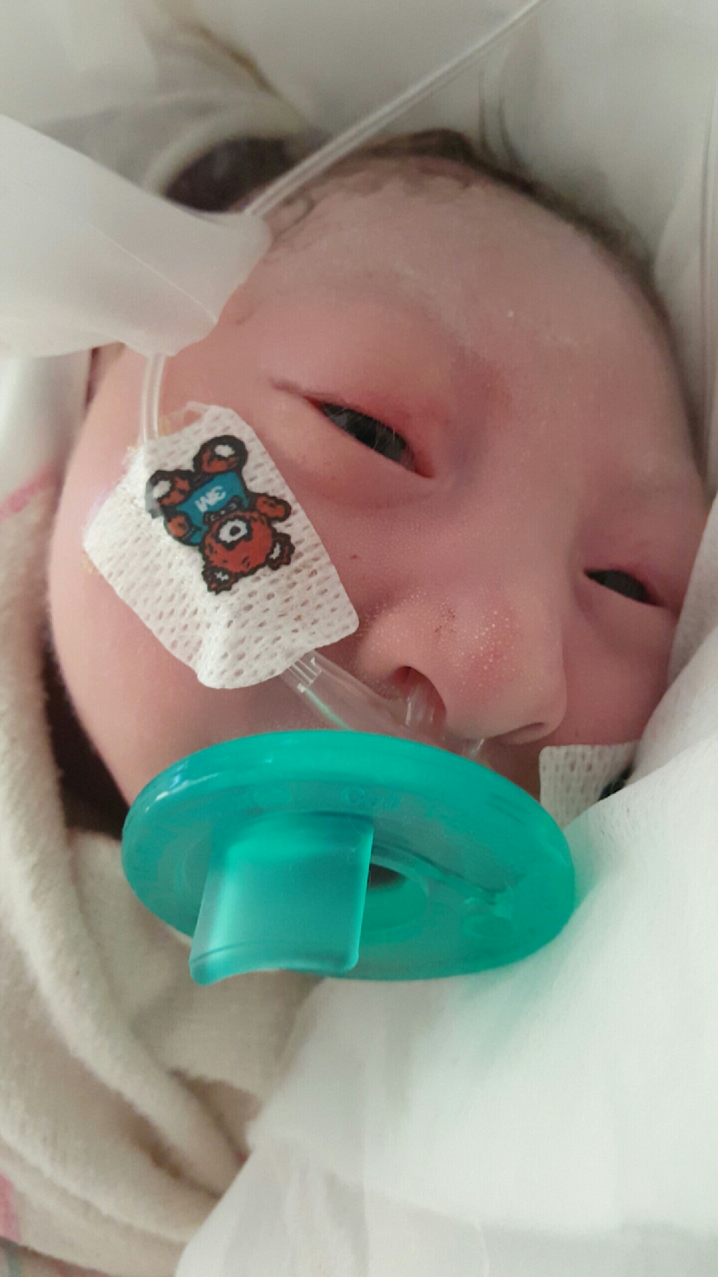 CHOC patient Michelle with a pacifier when she was in the NICU
