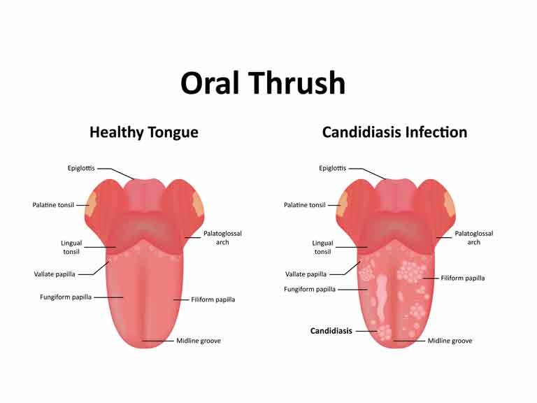 oral-thrush