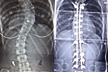 My journey with scoliosis: Casey’s story