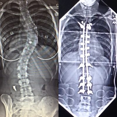 An X-ray of Casey's spine, before (left) and after (right) scoliosis surgery.
