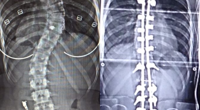 An X-ray of Casey's spine, before (left) and after (right) scoliosis surgery.