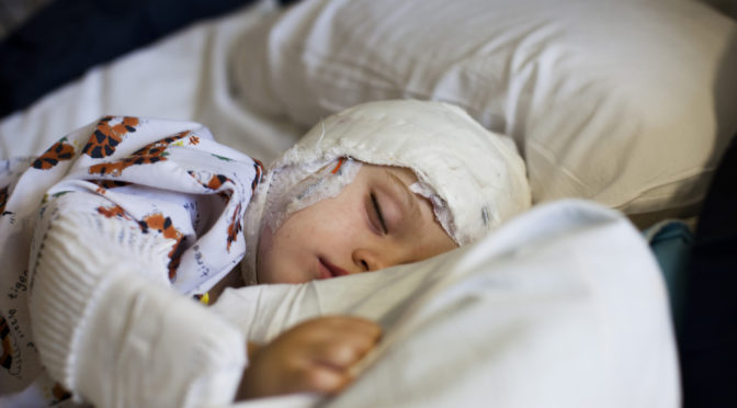 young boy with a bandaged head sound asleep
