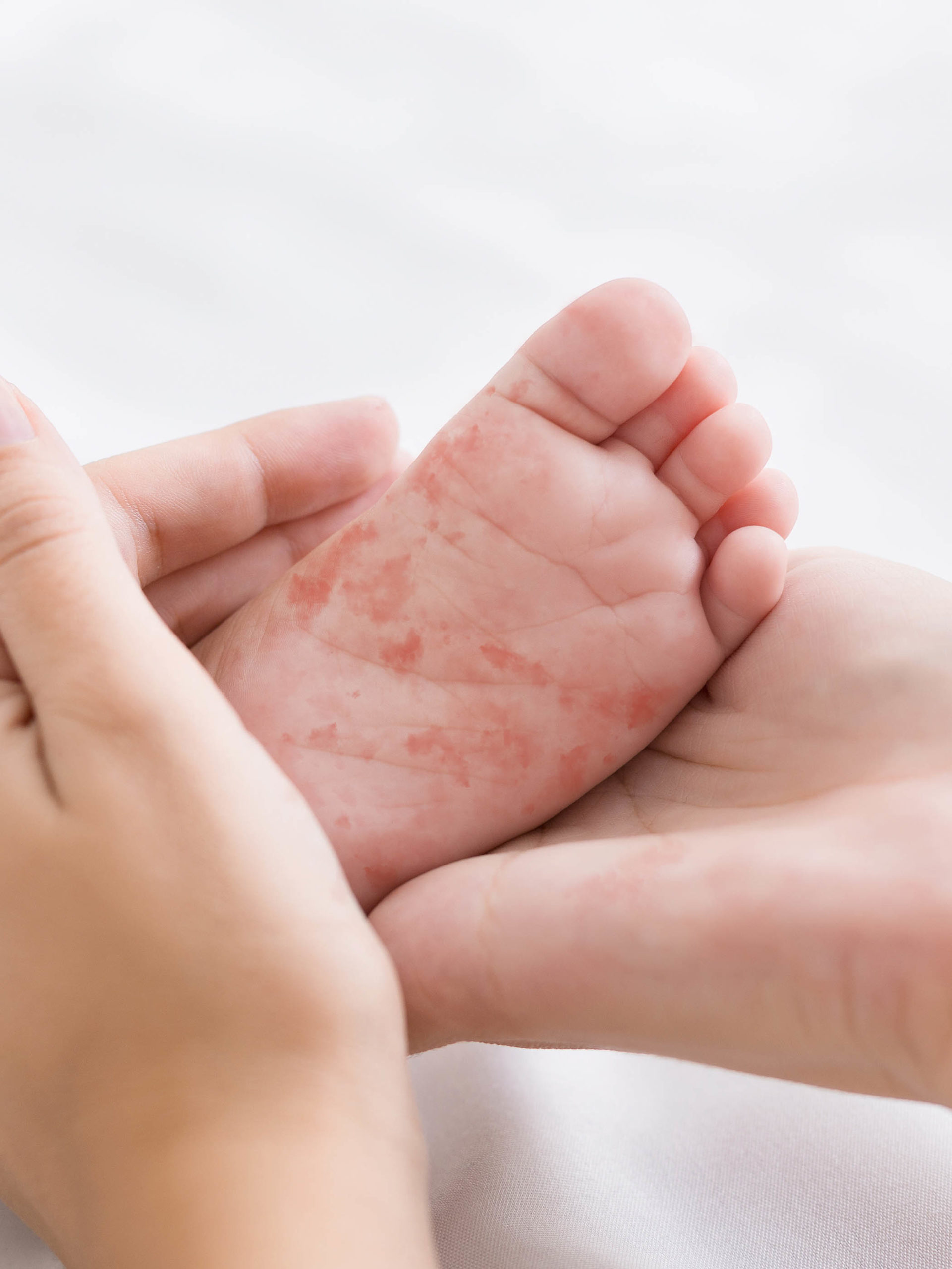 Mother holding tiny baby foot that has the measles