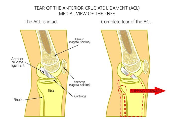 diagram of a torn ACL ligament