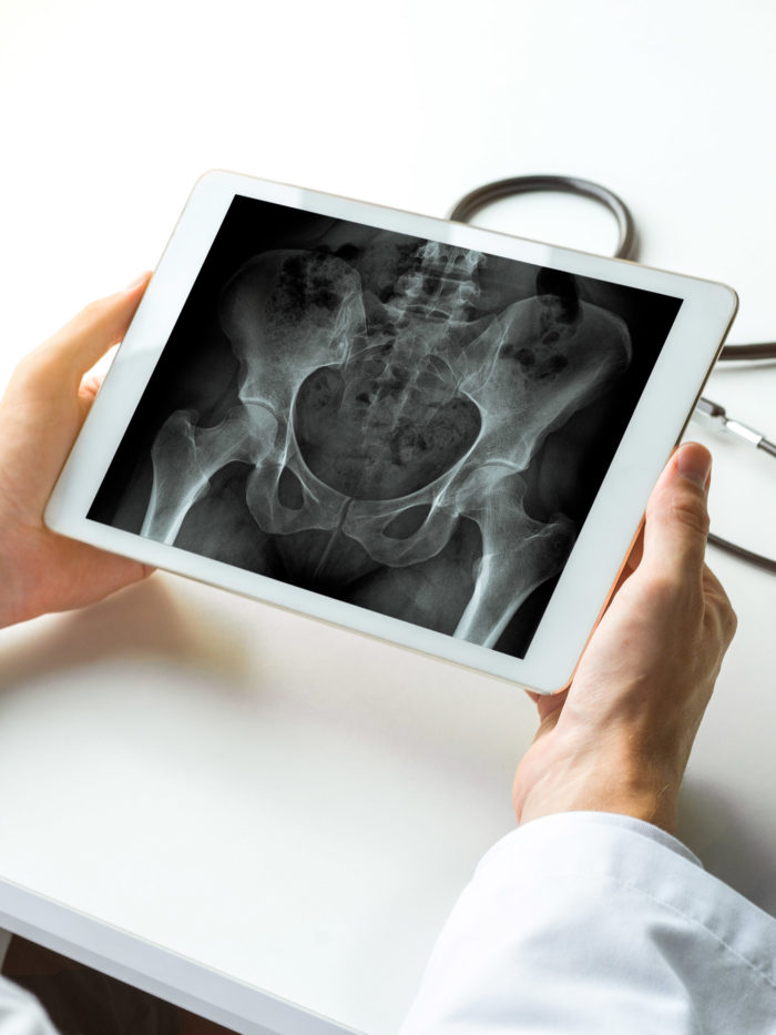 Doctor looking at x-ray of hips bones on a digital tablet
