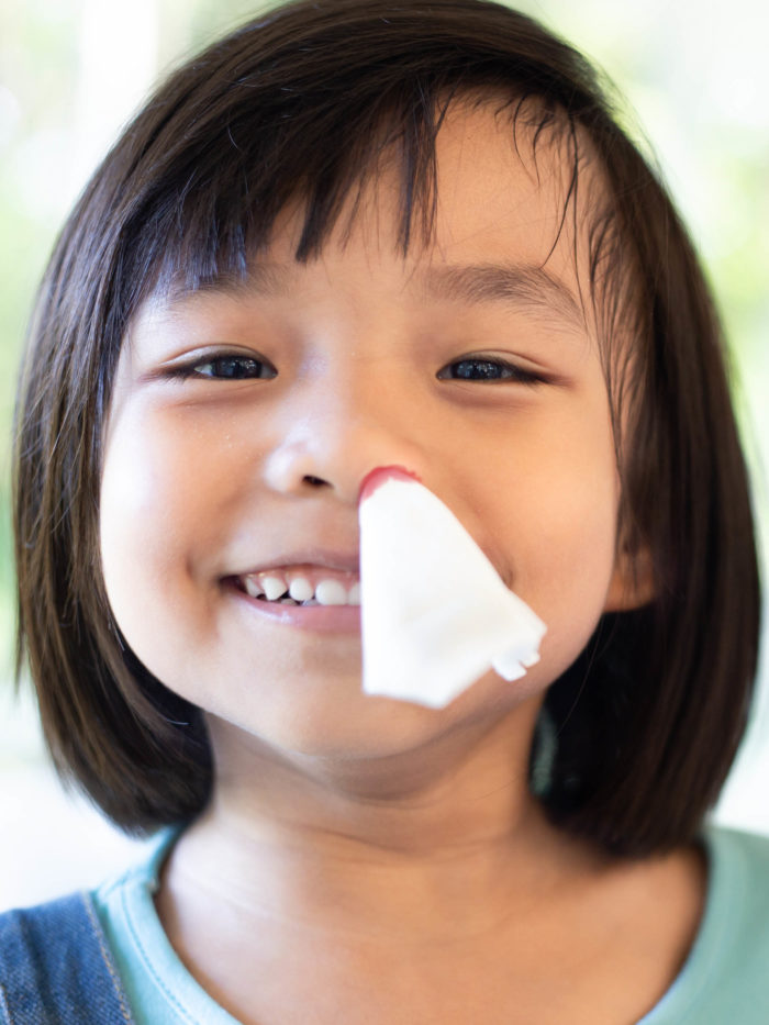 young girl with tissue in her nose to stop a nosebleed smiling at the camera