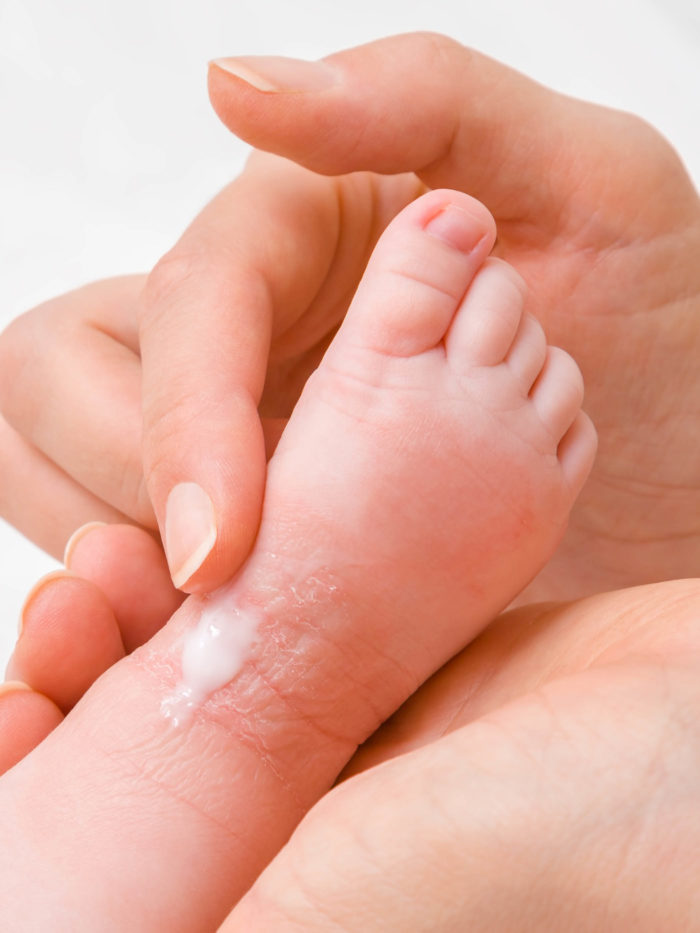 Mother carefully applying medical ointment to infant's foot