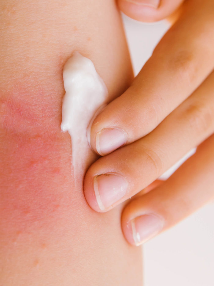 child smears cream on the irritated skin rash