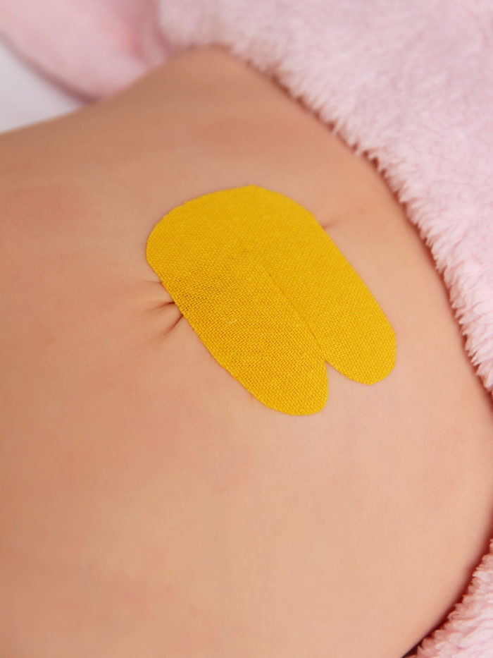 Kinesio taping to prevent umbilical hernia in child