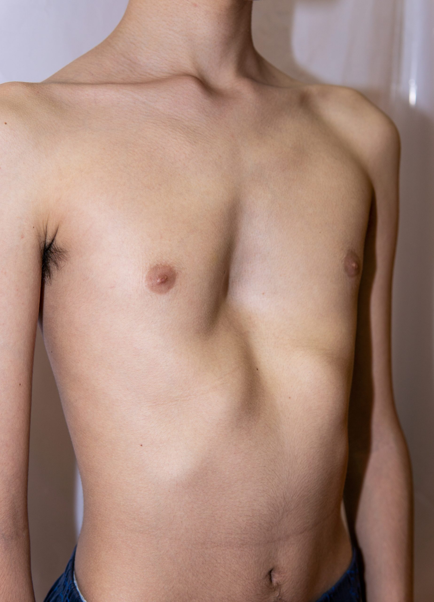 teenage boy with Pectus excavatum also known as sunken chest