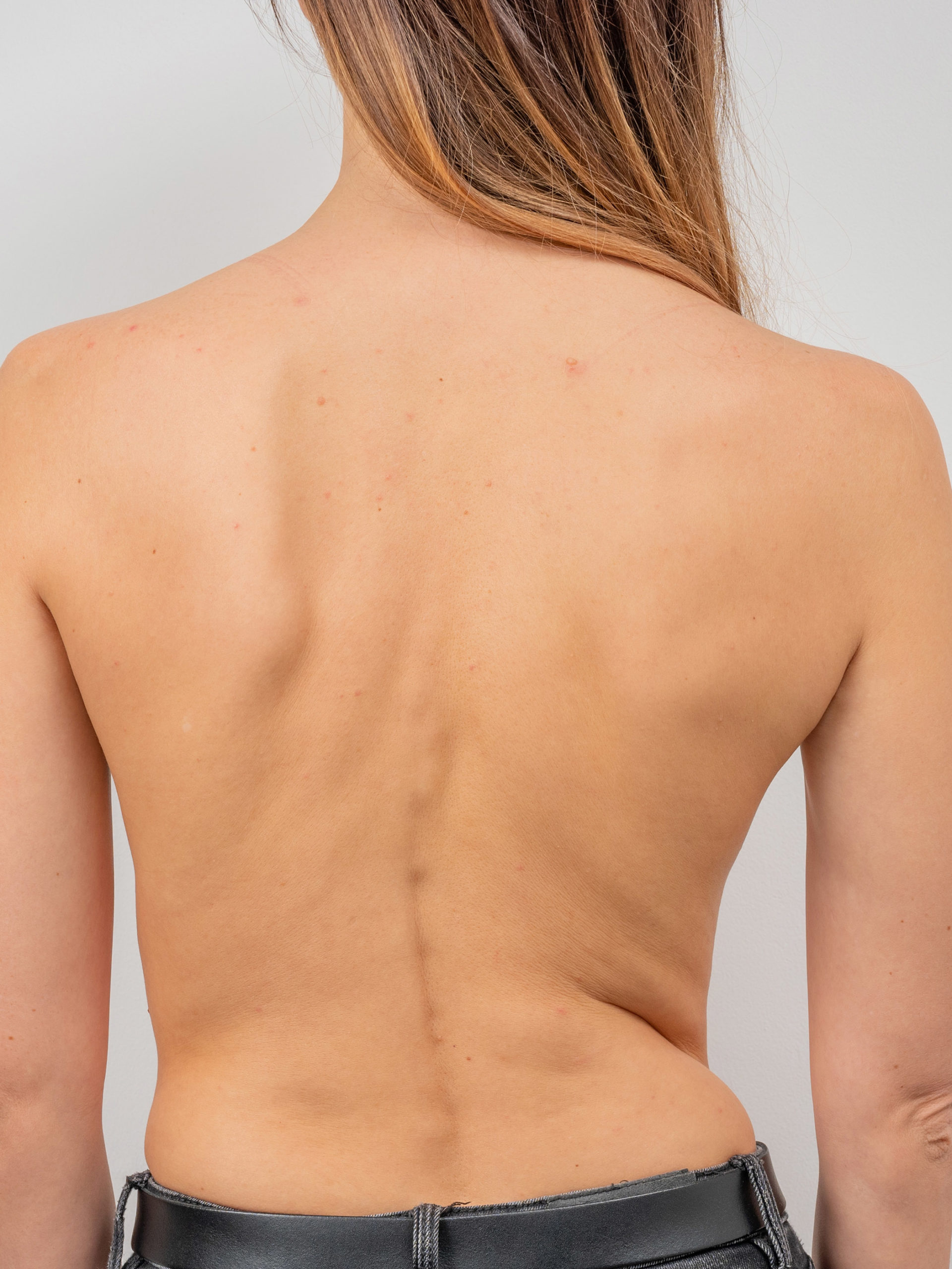 Young woman's bare back with scoliosis of the spine