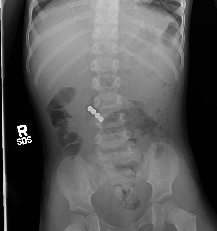 X-ray of stomach showing 4 round circles indicating magnets in patient's stomach