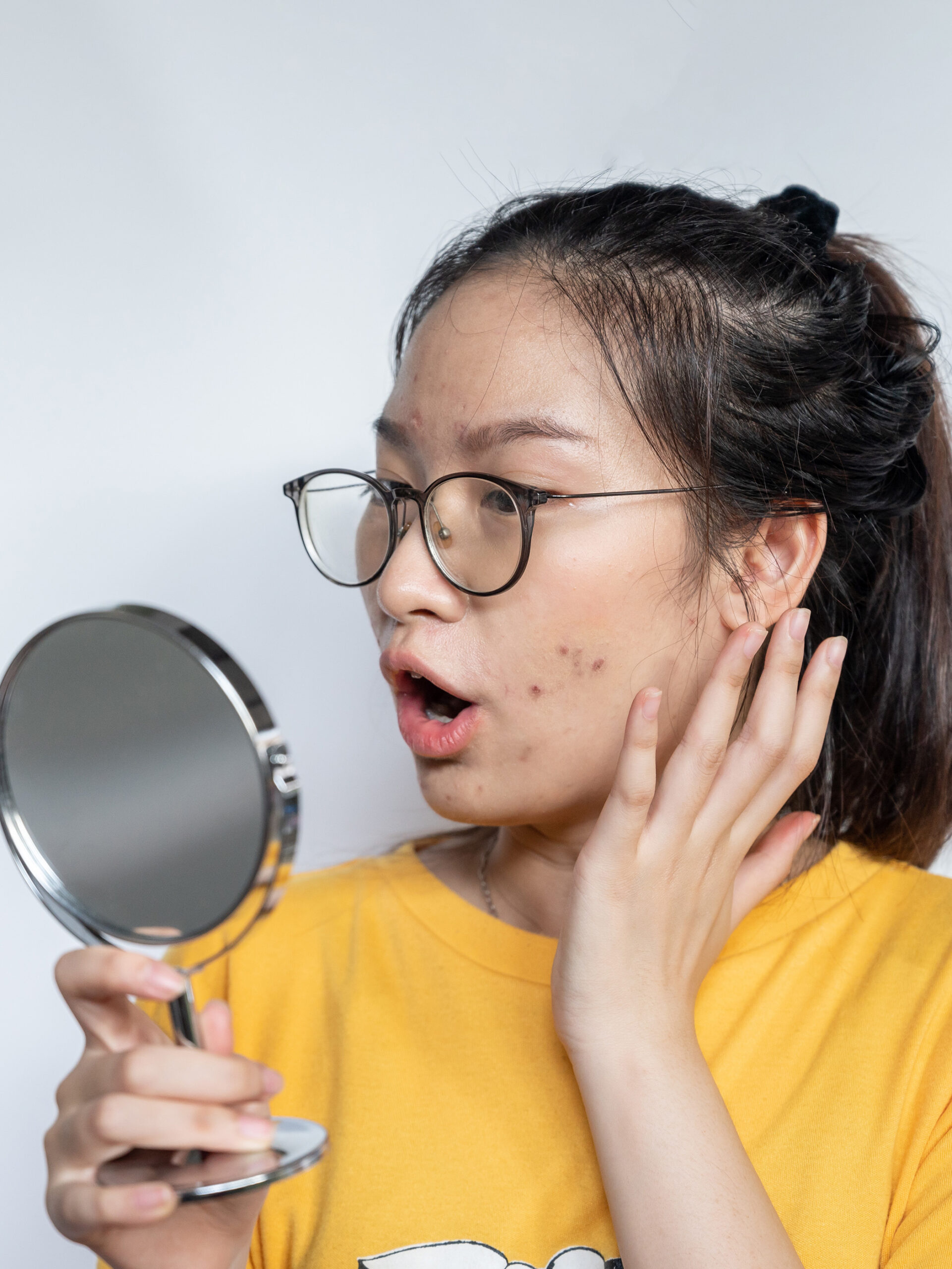 Person with acne looks at mirror
