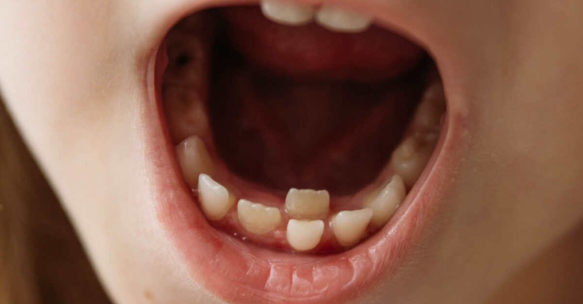 Patient Instructions after a Fluoride Varnish Treatment CHOC