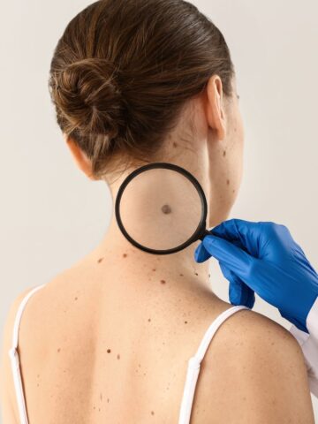 A gloved hand holding a magnifying glass over a skin mole on the back of a girl's neck
