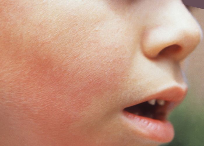 A boy with a rash caused by parvovirus on his face