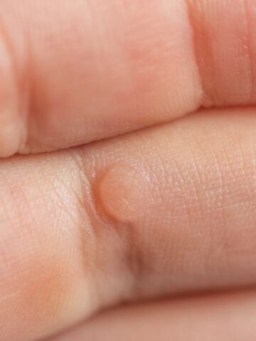 White person's fingers with a wart