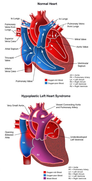 Ezra was diagnosed with Hypoplastic Left Heart Syndrome before birth, requiring him to undergo three open-heart surgeries.