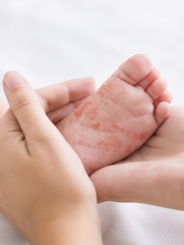 Mother holding tiny baby foot that has the measles