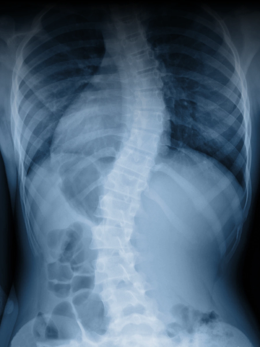 scoliosis film x-ray show spinal bend in teenager patient